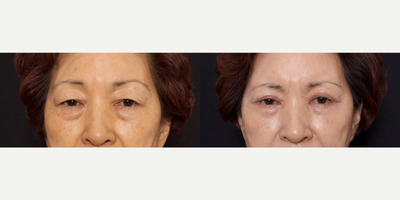 Woman treated with Double Eyelid Surgery - Woman treated with Double Eyelid Surgery
