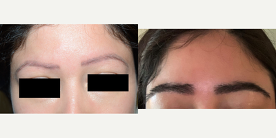 25-34 year old woman treated with Eyebrow Transplant - Result of eyebrow transplant 750 grafts