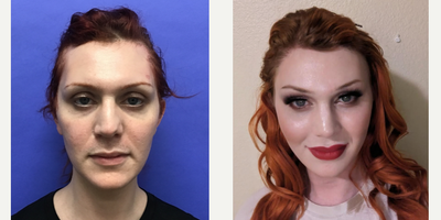 Patient treated with Transgender Facial Feminization Surgery, Facial Feminization Surgery, Cheek Augmentation, Revision Rhinopla - 25 to 34 year-old female patient is 2 years post-op from Facial Feminization surgery. Her procedures included: Forehead Lift, Hairline Lowering, Orbital Bony Contouring, Septorhinoplasty Revision (closed) with Cartilage Grafts, Cheek Implants (small), Chin Reduction and Contour, Soft Tissue to Nasolabial Folds, Intranasal Lip Lift with Fat Augmentation, Thyroid Cartilage Shave Revision and Voice Feminization, and 300 Micrografts. Patient is 4 months post-op from 450 Micrografts.