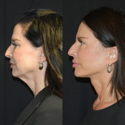 55-64 year old woman treated with Facelift, Neck Lift, Facial Fat Transfer - 6 months post op Facelift/ neck lift with fat transfer to face