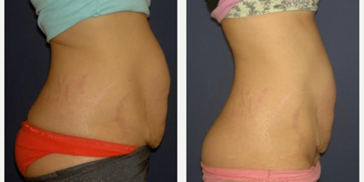 Woman treated with i-Lipo - Woman treated with i-Lipo