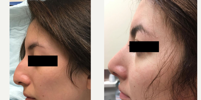 18-24 year old woman treated with Nose Surgery - Rhinoplasty in a young patient. She needed hump removed and tip rotation. This is only a few months after surgery so there is still some significant swelling.