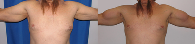 Man treated with Bicep Implants - Man treated with Bicep Implants