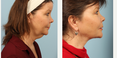 55-64 year old woman treated by  Renuvion Powered by Jplasma. - 56 year old female concerned with skin laxity who underwent Non-Invasive Skin Tightening with Renuvion Powered by Jplasma.