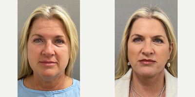 51 year old woman treated with Facelift, Neck Lift, Lower Facelift - 51 yo s/p facelift/ neck lift performed under local anesthesia with sedation in our on site AAAA certified operating suite.