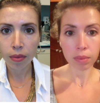 25-34 year old woman treated with Clear and Brilliant - Our esthetician and practice manager treats one of our patients with Clear&Brilliant fraxel technology. This laser has dual depths with minimal to no downtime. We treat our C&B patients with Oxygenetix post treatment and they go home with clear, calm skin.