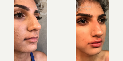 Woman treated with Nonsurgical Nose Job - Woman treated with Nonsurgical Nose Job