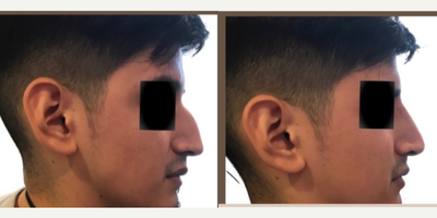 25-34 year old man treated with Nonsurgical Nose Job - Non-surgical Rhinoplasty using 1ml of Restylane Defyne