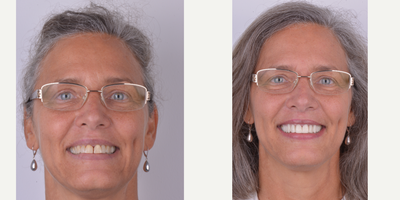 45-54 year old woman treated with Porcelain Veneers, Lumineers, Smile Makeover, Da Vinci Veneers - 20 Porcelain Veneers color Bleach 2, texture and digital design.