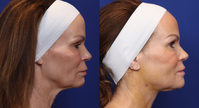 55-64 year old woman treated with Liposculpture - 40 cc of subcutaneious fat along with J-plasma skin tightening with the new Renuvion technology