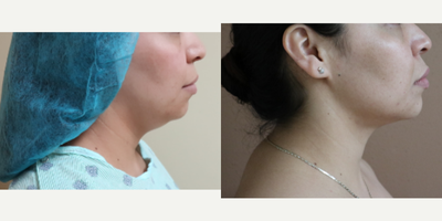 35-44 year old man treated with Liposuction - Submental Liposuction