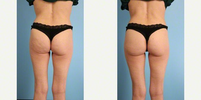 A 50 year-old woman treated with Cellfina - A 50 Year Old Woman Before and After a Cellfina Treatment by Andrew T. Lyos MD FACS.