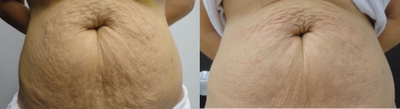 45-54 year old woman treated with Velashape - Client treated for stretch marks. 6 Sessions of Velashape and One Thermage session.
