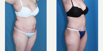 27 year old woman treated with Tummy Tuck, Thigh Lift, Brazilian Butt Lift - 27 year old woman treated with Tummy Tuck, Thigh Lift, Brazilian Butt Lift