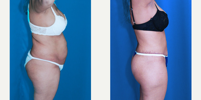 27 year old woman treated with Tummy Tuck, Thigh Lift, Brazilian Butt Lift - 27 year old woman treated with Tummy Tuck, Thigh Lift, Brazilian Butt Lift
