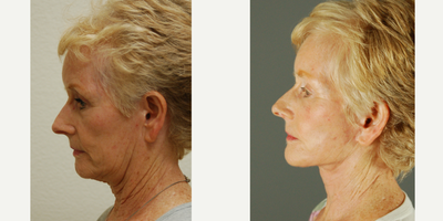 65-74 year old woman treated with Neck Lift - 4 months after facelift / necklift. 72 year old female.