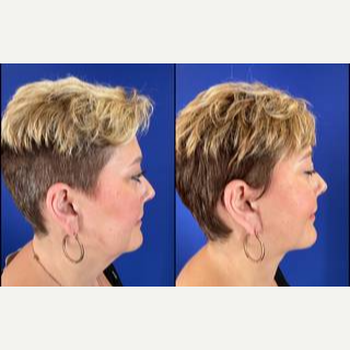 45-54 year old woman treated with Facelift - Facelift