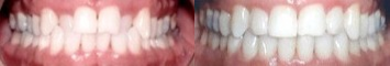 25-34 year old woman treated for Braces - Treatment of crossbite with braces