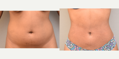 26 year old woman treated with Tumescent Liposuction - Liposuction Abdomen/ Flanks