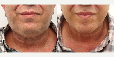 MACS Facelift and Neck Platysmaplasty - MACS Facelift and Neck platysmaplasty procedure by Dr. Charles Lee in San Francisco. The Patient showed satisfaction with the results, reporting a boost in self-confidence and an overall rejuvenated appearance. The procedure enhanced the patient's natural jawline and reduced the appearance of the platysmal bands of the neck, while supporting youthfulness.