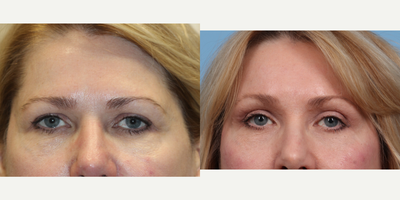 57 year old woman treated with Brow Lift and Upper Blepharoplasty - 2 months post op