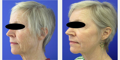 55-64 year old woman treated with CO2 Laser, Smartlipo, Filler and Xeomin - Smartlipo treatment of the neck and SmartSkin CO2 laser treatment of the facial rhytids, Radiesse volumizing treatment of the malar area and Belotero treatment of the perioral and lip area. Xeomin treatment of the brow and periocular rhytids.
