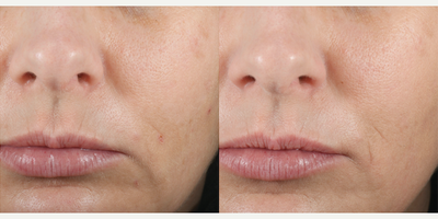SkinCeuticals, Resveratrol BE - Resveratrol BE. Skinceuticals H.A. Intensifier was used twice daily in conjunction with Gentle Cleanser and a sunscreen. Efficacy and tolerability evaluations were conducted at baseline and at weeks 4, 8, and 12. Photo provided courtesy of SkinCeuticals.