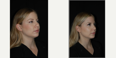 25-34 year old woman treated with Kybella - 25-34 year old woman did not like her 'double chin', she was treated with Kybella and loves it!