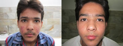 Acne Treatment - 
	18 years old male, presented with severe Acne. I started his treatment with Accutane, after 4 months results are clearly remarkable.
