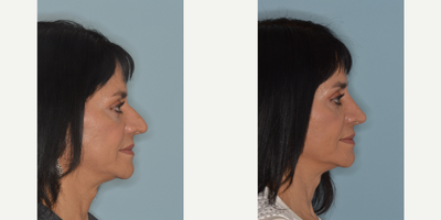45-54 year old woman treated with Rhinoplasty - Challenging primary rhinoplasty on a female patient with thick nasal skin whose primary concerns include the droopiness of her tip and the over projection of her bridge on the profile view. Primary rhinoplasty techniques included bilateral osteotomies, bilateral spreader grafts, hump reduction, caudal septal extension graft for tip support, lateral crural repositioning, and alar flare reductions.