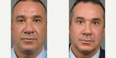 Man treated with Botox, Dermal Fillers - To create this dramatic yet natural result, Dr. Marotta used a combination of Botox and fillers to soften lines and wrinkles and replace the volume he had lost.