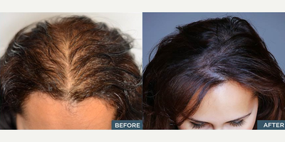 Woman treated with Scalp Micropigmentation - Woman treated with Scalp Micropigmentation