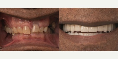 55-64 year old man treated with All-on-4 Dental Implants, Dental Implants, Full Mouth Reconstruction - The patient came in with severe dental issues and left with a fully restored, natural-looking smile thanks to All-On-4.
