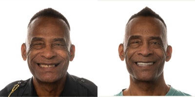 55-64 year old man treated with All-on-4 Dental Implants, Dental Implants, Full Mouth Reconstruction - The patient came in with severe dental issues and left with a fully restored, natural-looking smile thanks to All-On-4.
