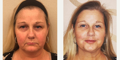 Woman treated with Restylane - Woman treated with Restylane as fillers to restore the volume to the lips. Patient was also treated with Restylane Lyft for her cheeks, nasolabial folds and marionette lines, and also dysport between her eyebrows to soften the frown lines. She is shown before and immediately after the treatment.