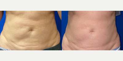 Woman treated with truSculpt iD - Woman treated with one treatment of truSculpt iD, shown 9 weeks post op.