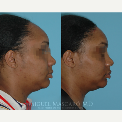 25-34 year old woman treated with Forehead Reduction - 1 week after forehead shortening/hairline advancement. We were able to advance the hairline 3 cm in this case.