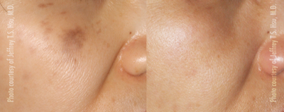 25-34 year old woman treated with Enlighten - 2 treatments