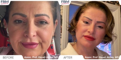 45-54 year old woman treated with Deep Plane Facelift, Facelift, Facial Fat Transfer, Eyelid Surgery, Neck Lift - 45-54 year old woman treated with Deep Plane Facelift, Facelift, Facial Fat Transfer, Eyelid Surgery, Neck Lift
