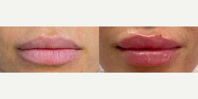 Woman treated with Lip Fillers - Woman treated with Lip Fillers