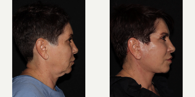 55-64 year old woman treated with Facelift - Quicklift Deep-Plane Facelift (Additional Procedures: Eyelids)