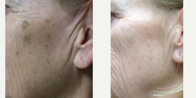 45-54 year old woman treated with Laser Treatment - One treatment with GentleMax Pro for brown spots