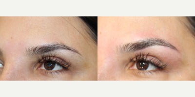 35-44 year old woman treated with Microblading, Permanent Makeup - Microblading is a precision-based form of cosmetic tattooing designed to enhance and restore natural brow shape. Each treatment is performed by Ruth Swissa, CMM, a leading expert in medical micropigmentation.Using a sterile, single-use microblade, ultra-fine pigment is deposited into the superficial dermis to create realistic, hair-like strokes that blend seamlessly with existing brow hair. Each procedure includes a detailed facial analysis and custom brow mapping to ensure symmetry, balance, and a tailored result.Ideal for patients with thinning brows, asymmetry, or hair loss, microblading delivers soft, natural-looking enhancement with results that continue to refine as the pigment settles. *A follow-up session is recommended to perfect the final outcome.