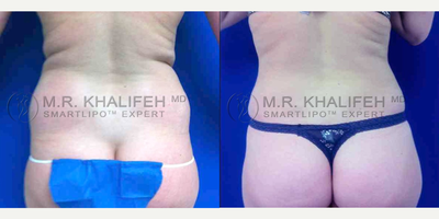 Woman treated with Vaser Liposuction - Woman treated with Vaser Liposuction