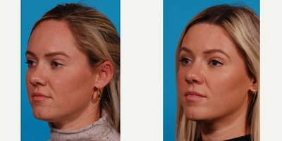 25-34 year old woman treated with Forehead Reduction - Young woman interested in reducing the size of her forehead. Procedure also called hairline advancement. Pt was able to consult with Dr. Olson remotely, since at the time lived in another state.
