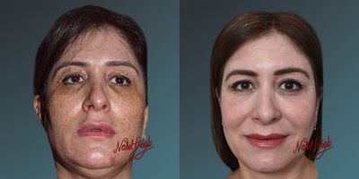 45-54 year old woman treated with Pulsed Dye Laser - In skin rejuvenation, laser protocols with various wavelengths now offer different solutions for treating spots and scars. Considering the ratio of skin issues such as spots, veins, keratosis, freckles, warts, moles, etc., along with skin color, age, and environmental damage.