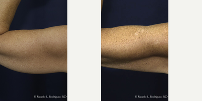 Liposuction - Liposuction to arms
