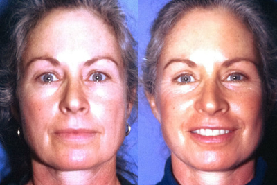 This 44-year-old Woman received a Face Lift, Blepharoplasty, and Rhinoplasty - This 44-year-old Woman received a Face Lift, Blepharoplasty, and Rhinoplasty.