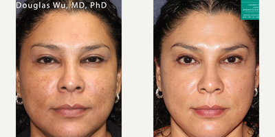 Woman treated with PicoWay - Vbeam and PicoWay to treat brown spots by Dr. Wu