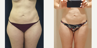 25-34 year old woman treated with Liposuction - Beautiful post op results in this 32 year old patient from Toronto, Canada two months after 360 liposuction and Brazilian butt lift with Premium Care. Surgical time was 2.5 hours using two plastic surgeons, and she spent one week after surgery recovering in Cartagena at our five star Recovery Suites. Her figure looks amazing!